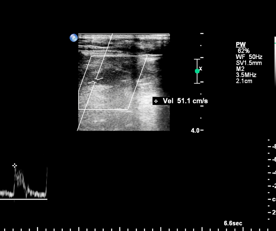 Untersuchung von Erkrankungen der BlutgefäÃe mit Ultraschall