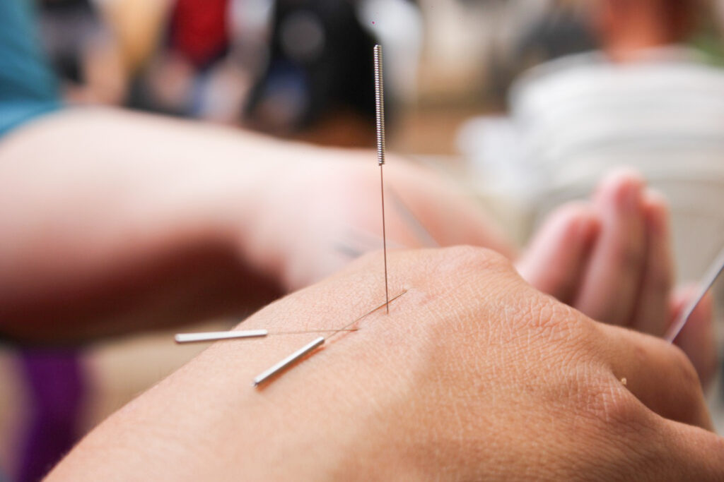 acupuncture-6324472_1280-2-1024x683