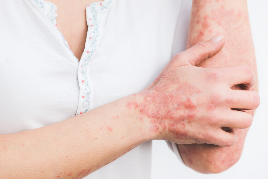 psoriasis-5996424_1280-2-1024x683